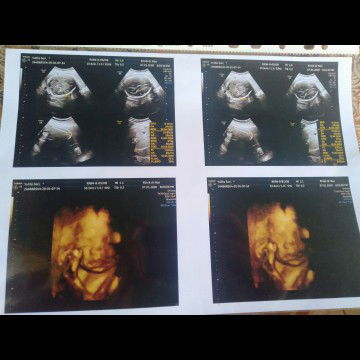 mengenai cairan dikepala baby..  saya udh USG 2x bun ,yg prtma kta dokternya ada cairan dikepala baby ku ,dan yg ke dua sya USG tmpat lain tapi kata dokter nya emang ada cairan tapi pas diukur cuma 0,6 cairan nya trus sya tanya itu cairan hydrosafelus buk