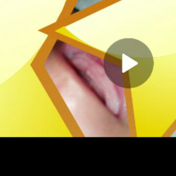 benjolan putih d gusi bayi