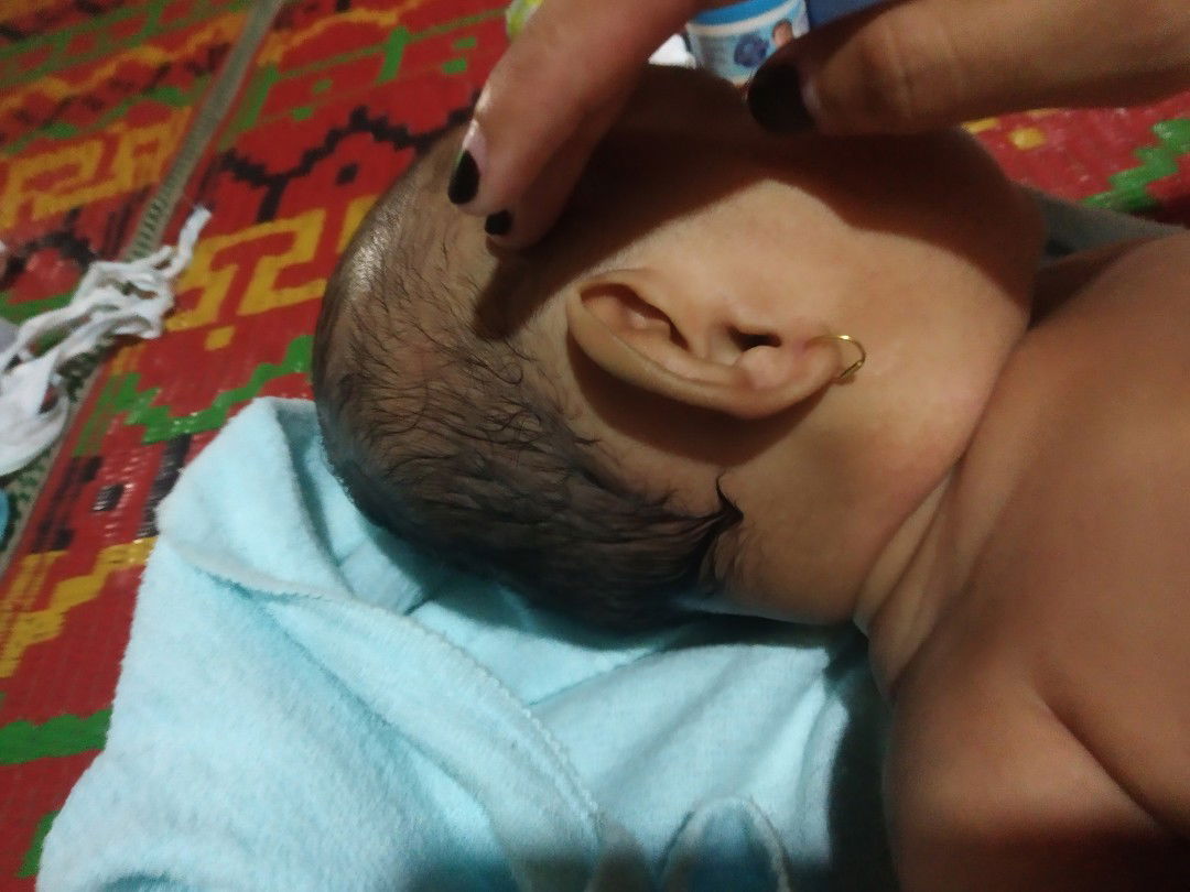 benjolan di bawah telinga