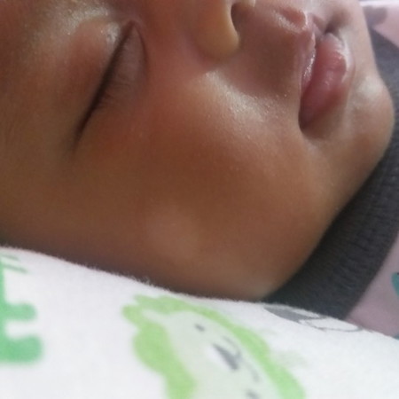 bercak putih di pipi
