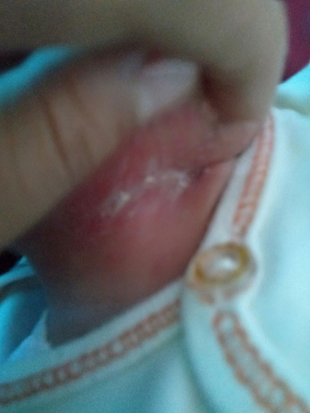 Leher merah pada bayi