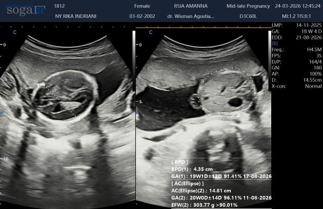 Hasil USG
#mohonbantujawabbunda🥲🥲🥲