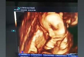 penyumbatan di tali plasenta.. !