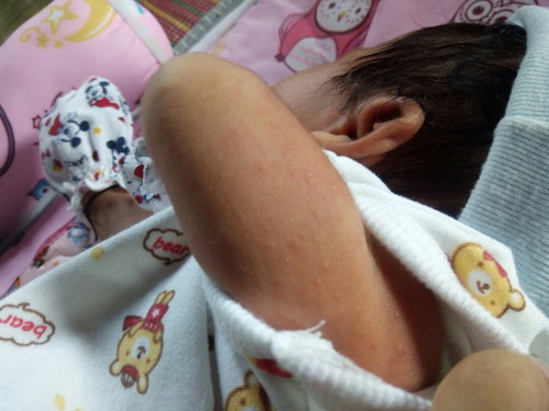 มันคือตุ่มอะไร