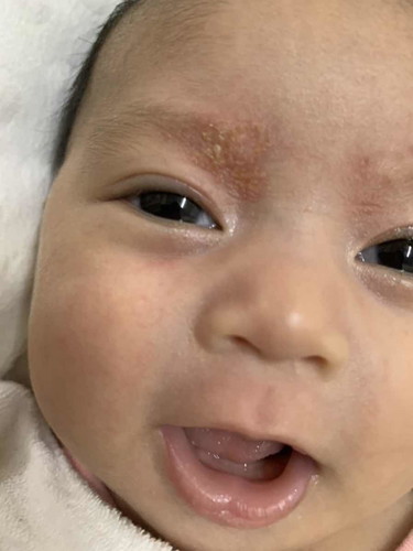 Kerak kering biasa atau mslh lain