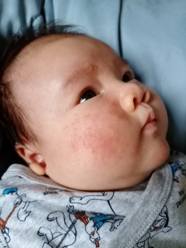 น้องได้เดือนกว่า เป็นผื่นที่แก้ม