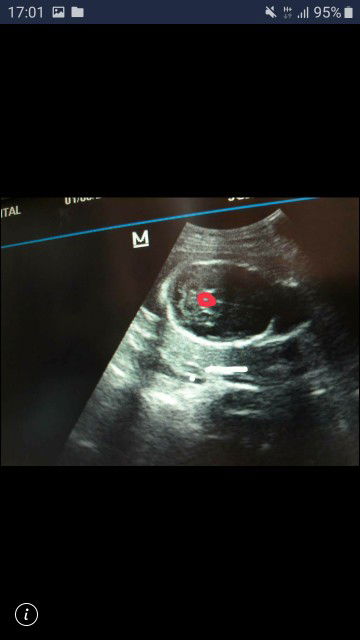 ??24วีค เเล้ว ค่ะวันนี้หมอนัด เลยได้รู้เพศน้อง