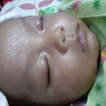 bintik2 merah di wajah baby