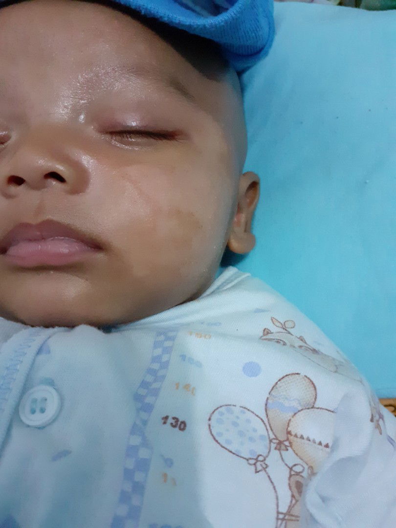 kulit bekas ruam jdi putih