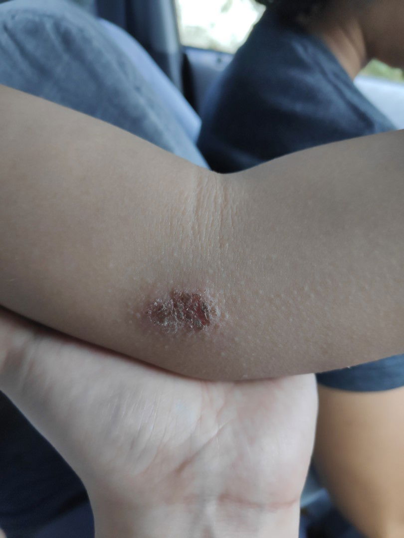 Is it bec of her G6pd?