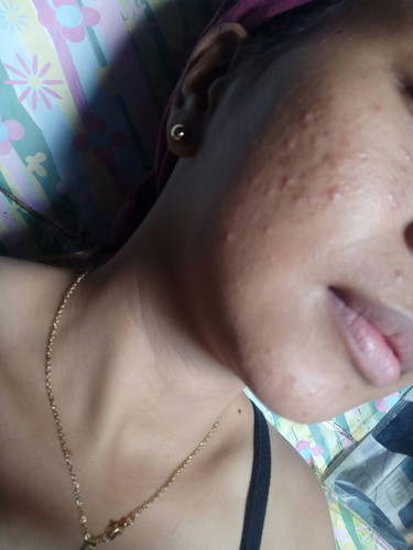 pimples