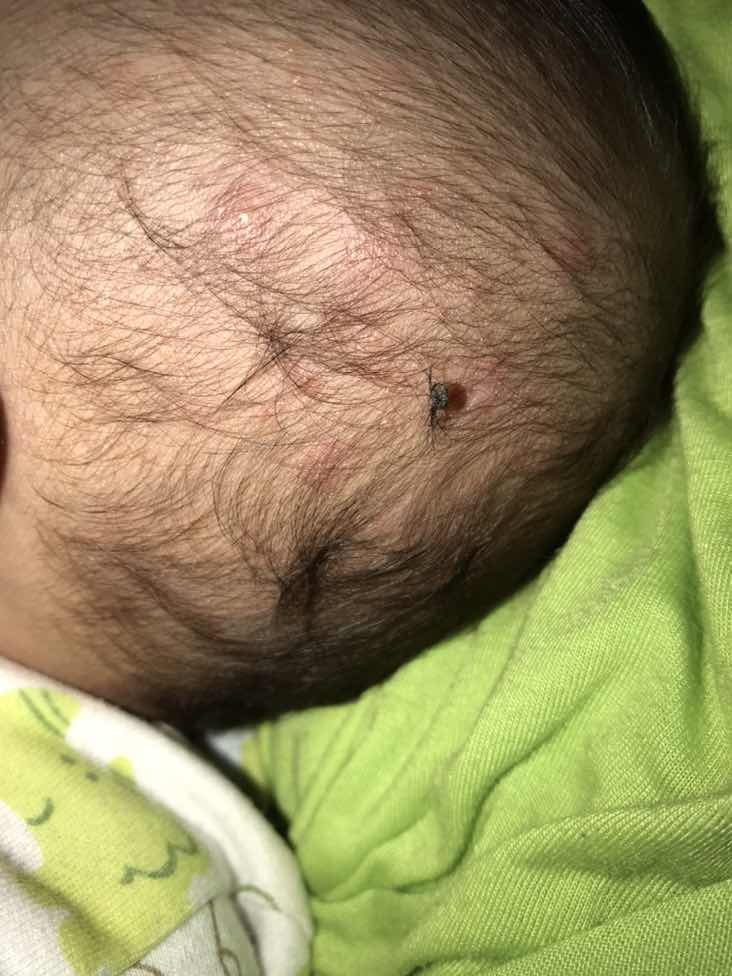 Benjolan merah dikepala