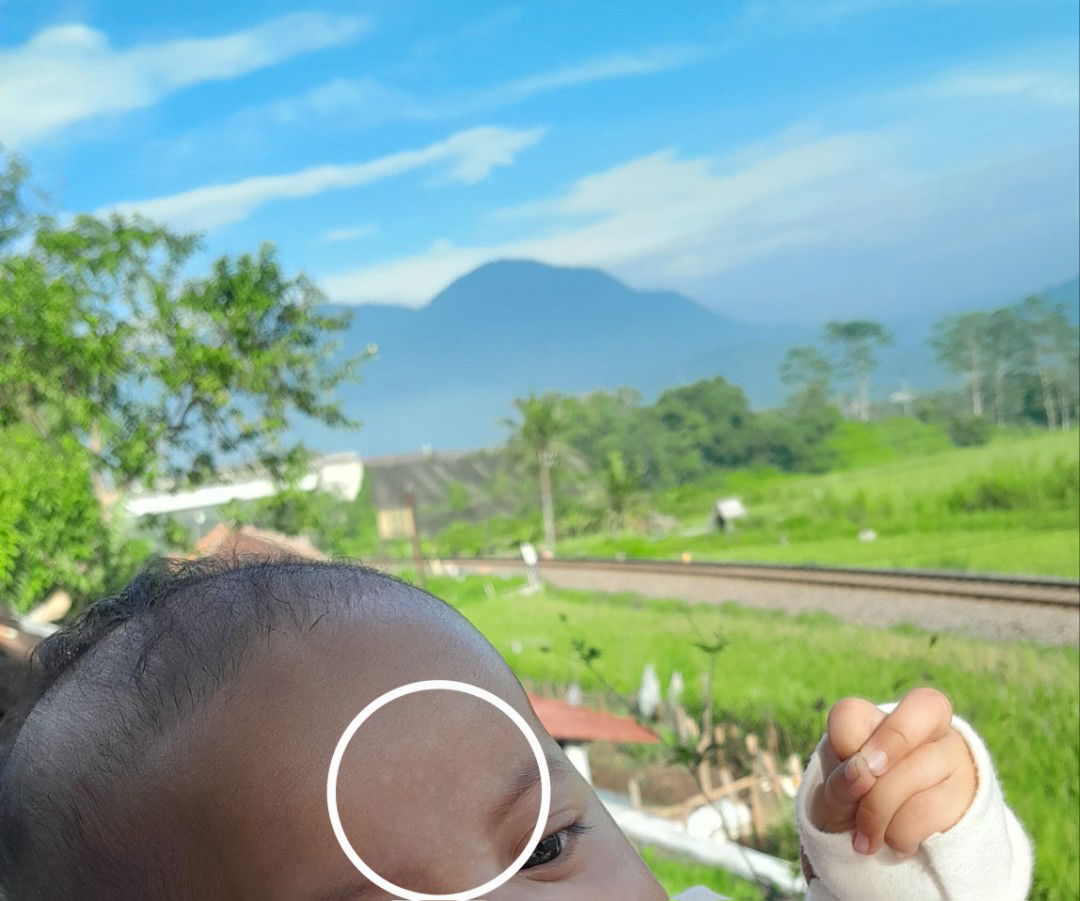 Bayi 3 bulan ada bercak putih di wajah