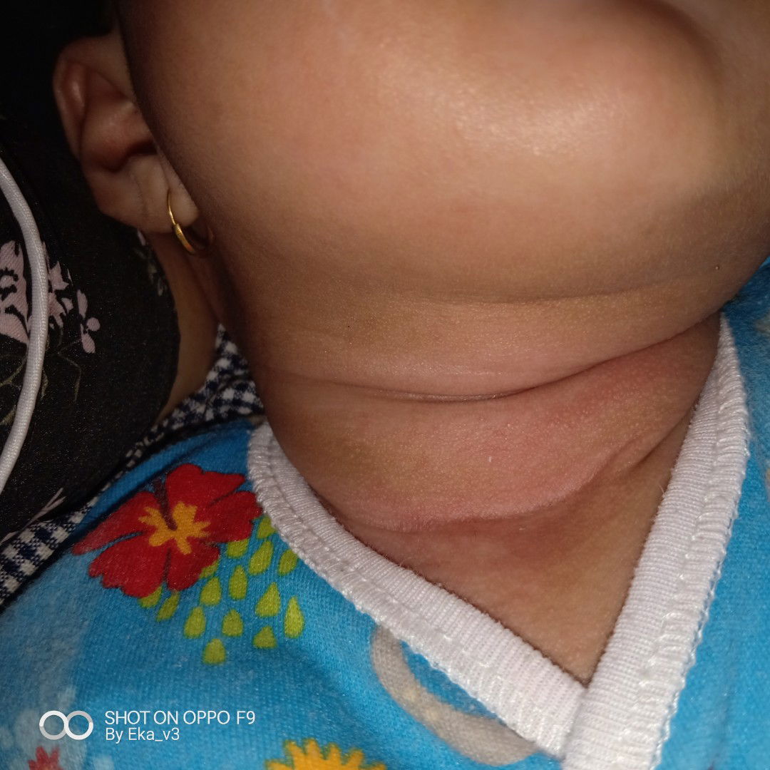 merah2 pada leher bayi