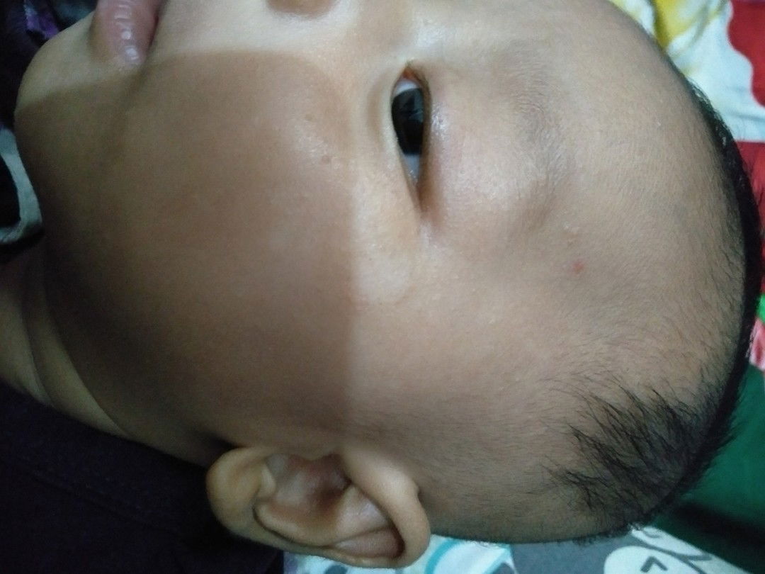 bercak putih di pipi