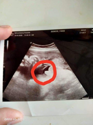 อัตซาวด์