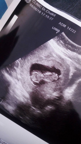 เป็นเบาหวานอยากมีลูกอีกจะได้ไหมคะ