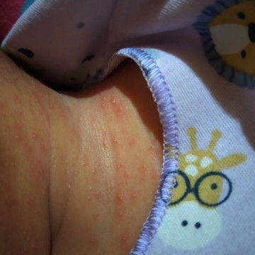 merah2 pada badan bayi