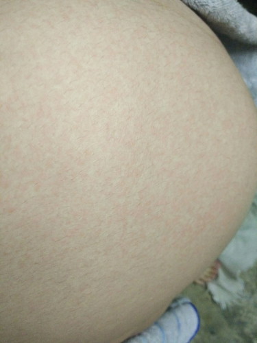 ผื่นแดงขึ้นท้องแล้วคัน