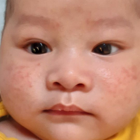 bị mụn hai bên má