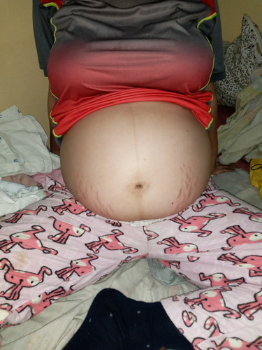 STRETCH MARK