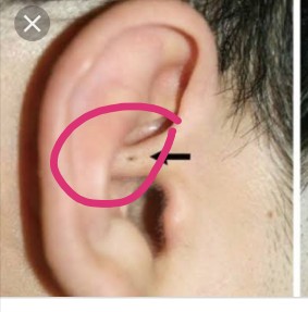 Tiny Hole Sa Tenga Ni Baby