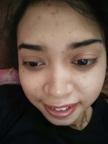 jerawat nakal