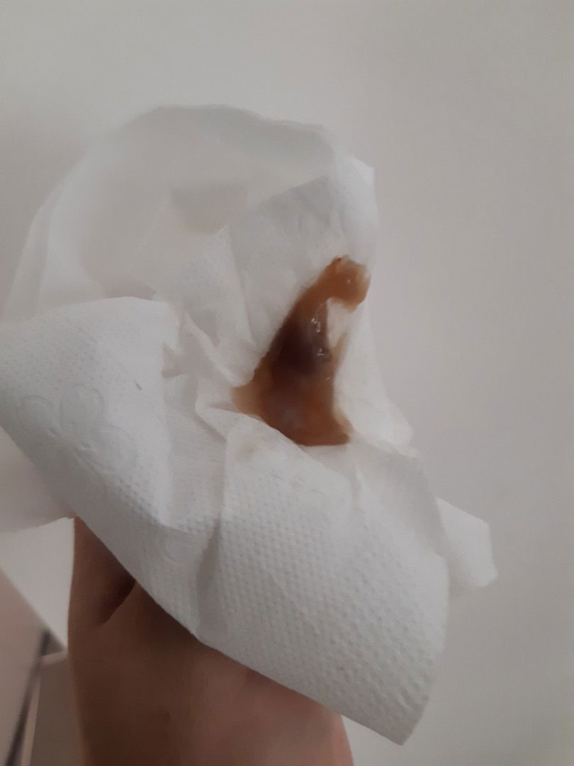 38 w มูกเลือดอีกแล้ว แต่...