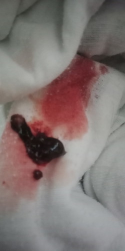bleeding
