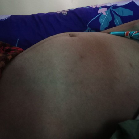 อายุครรภ์ 33 สัปดาห์ แต่ท้องเล็ก