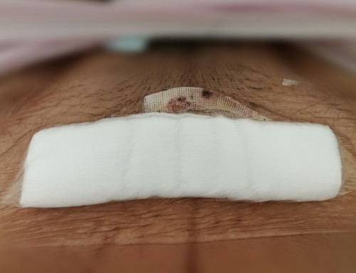 แผลผ่าคลอด