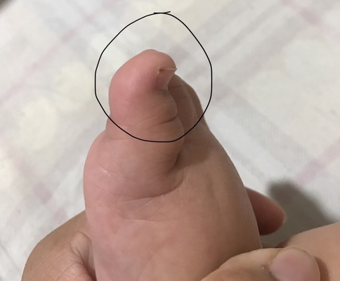 Toe nail