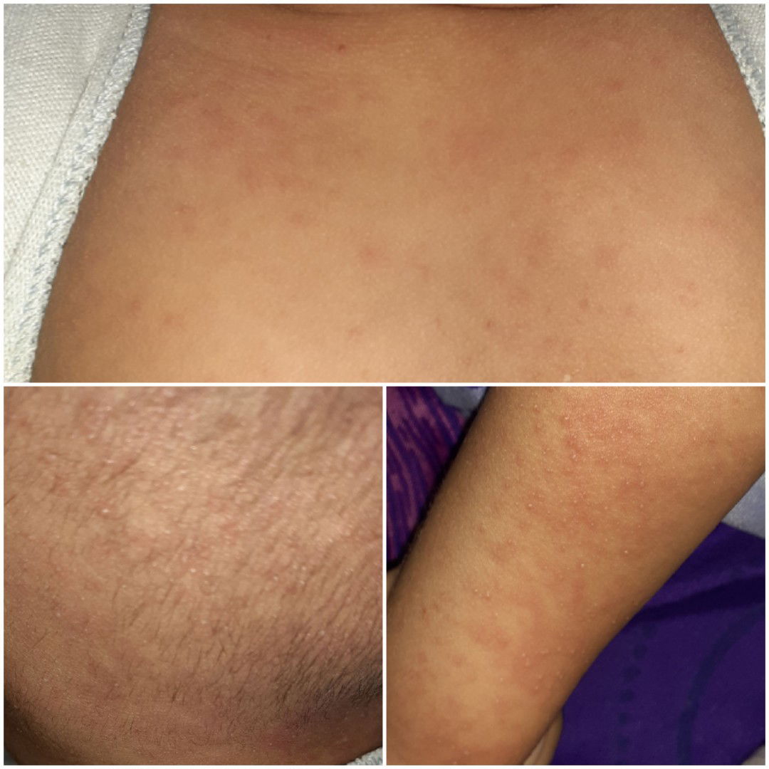 bintik setelah demam