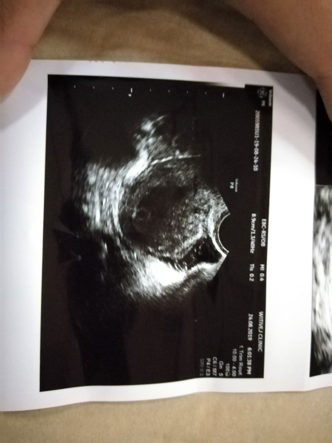 ถุงตั้งครรภ์เล็กลง​