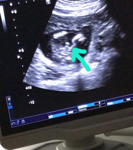 baby boy?