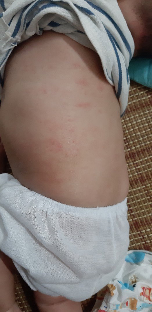mụn