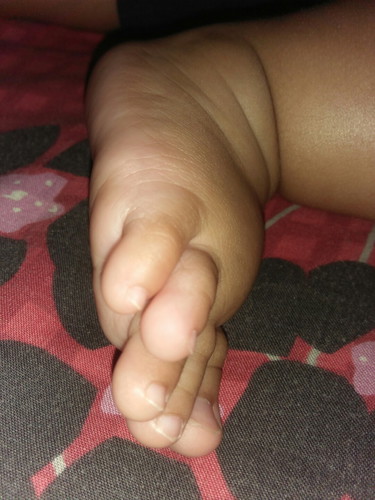 jari kaki bertindihan