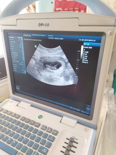 beda usia kandungan .