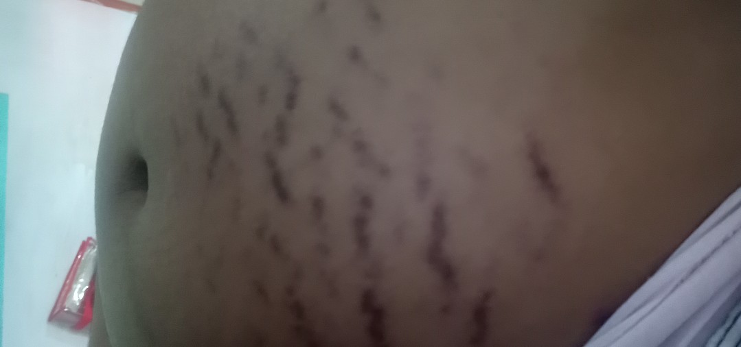 Stretch Mark