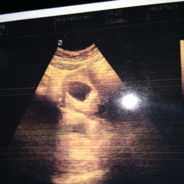 usia 8 minggu janin belum terlihag