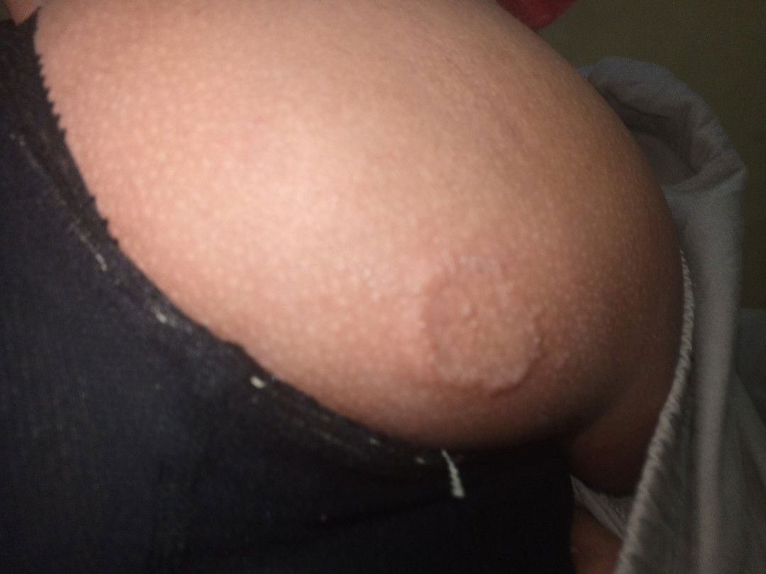 Gatal dan muncul bercak merah timbul