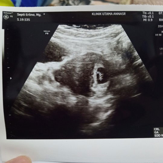 hasil USG 6 week 1 day