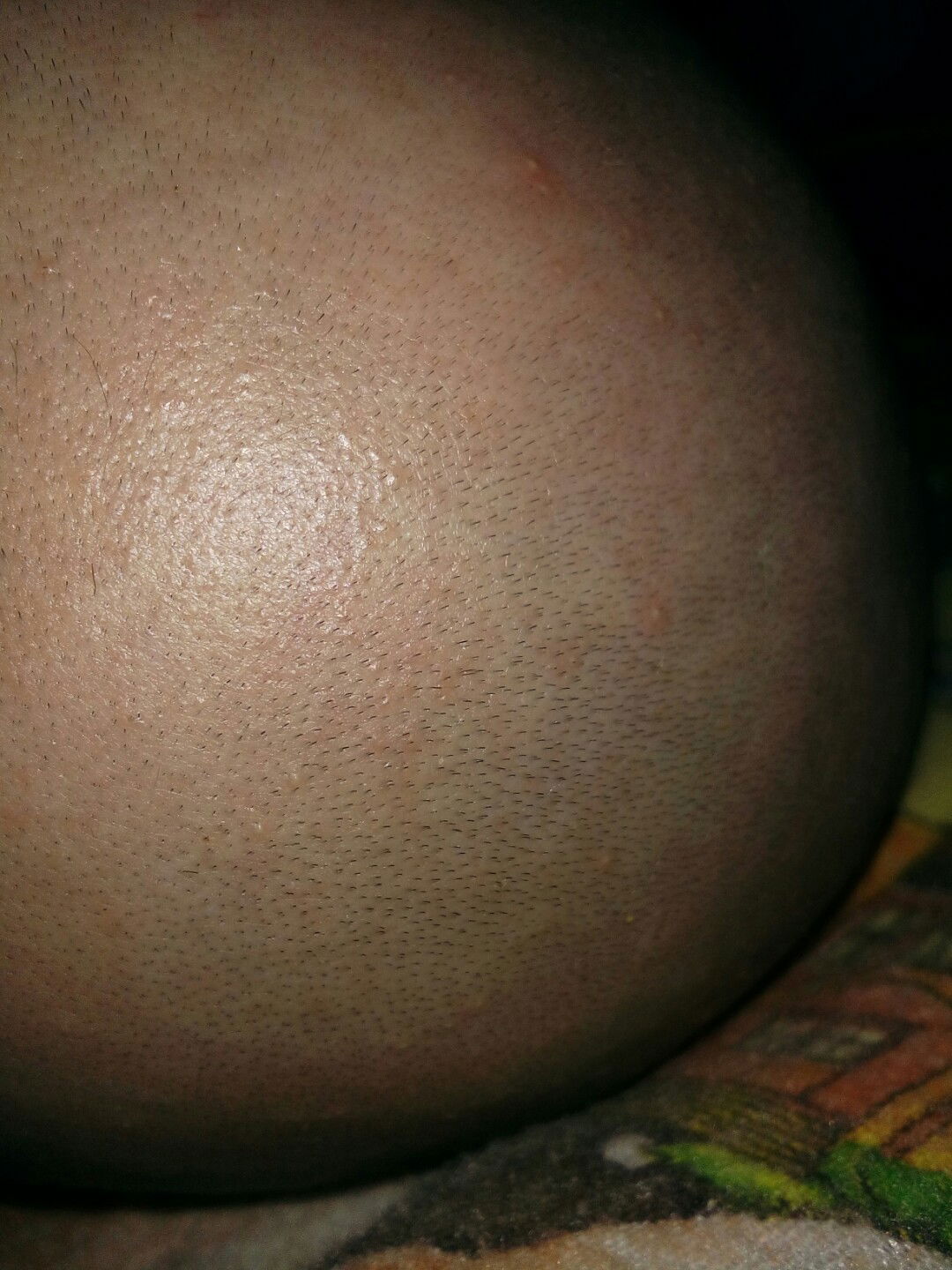 beruntusan kepala bayi