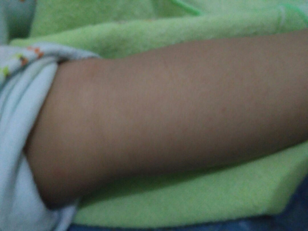 bintik2 merah pada pipi tangan umur bayi 3bln 15hari