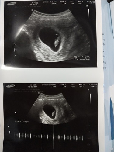 อัลตราซาวนด์