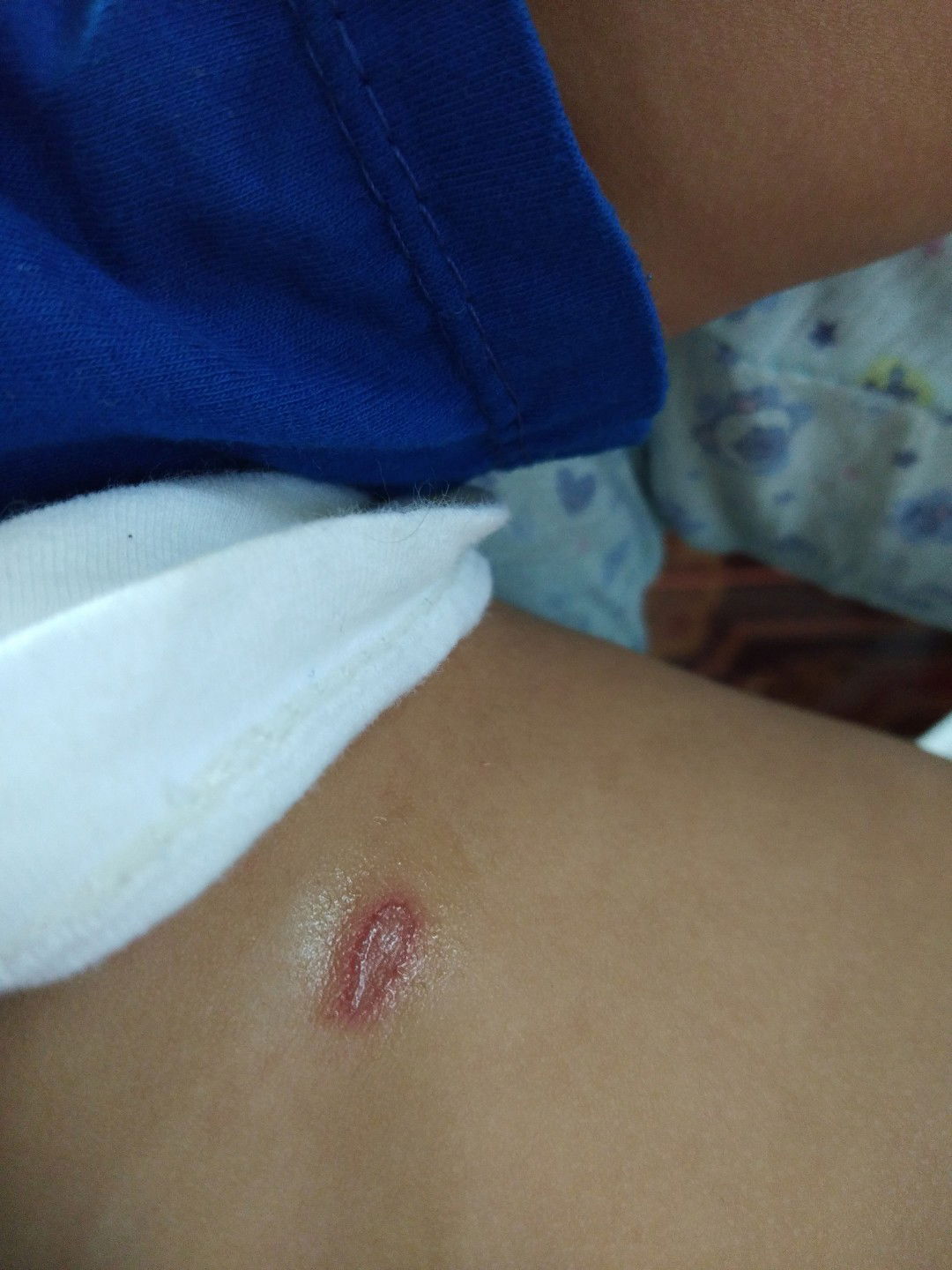 timbul seperti luka lepuh pd bayi