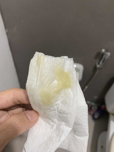 Yellowish sticky discharge 40weeks