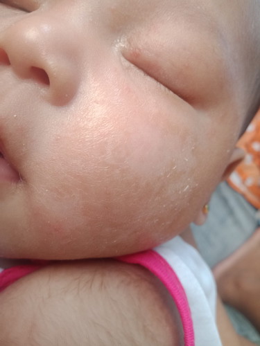 Dry Skin ni Baby