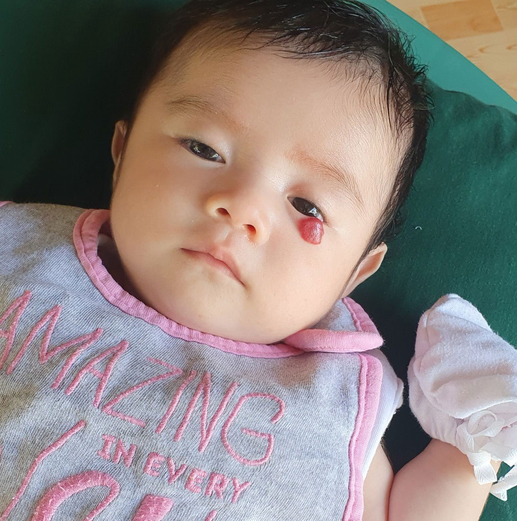 Hemangioma Treatment?