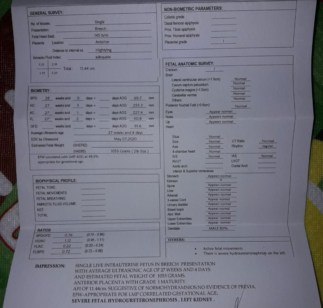 Severe fetal hydroureteronephrosis
